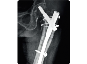 Hệ thống nẹp kim loại CHS